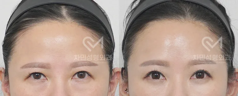 측면