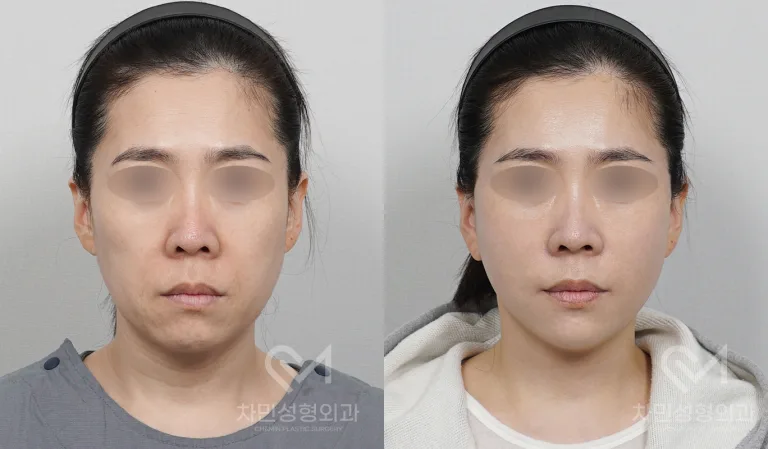 측면