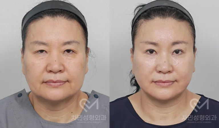 측면
