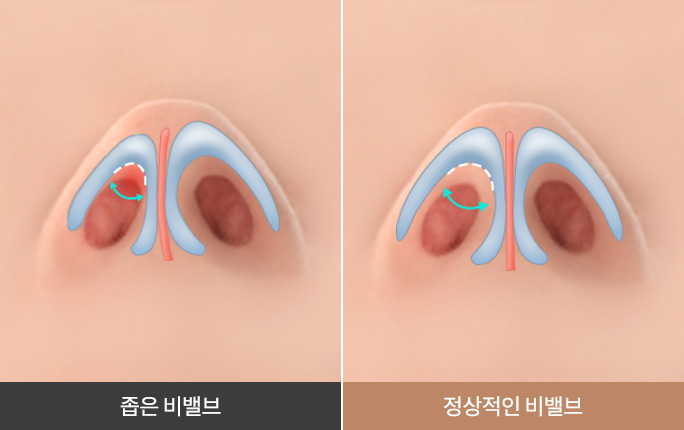 비밸브 협착증