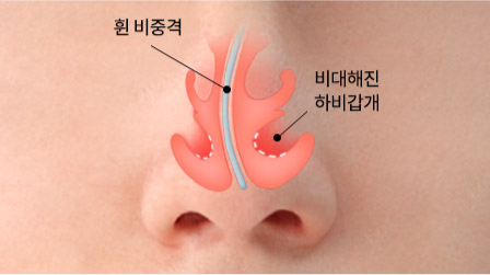 코의 질환