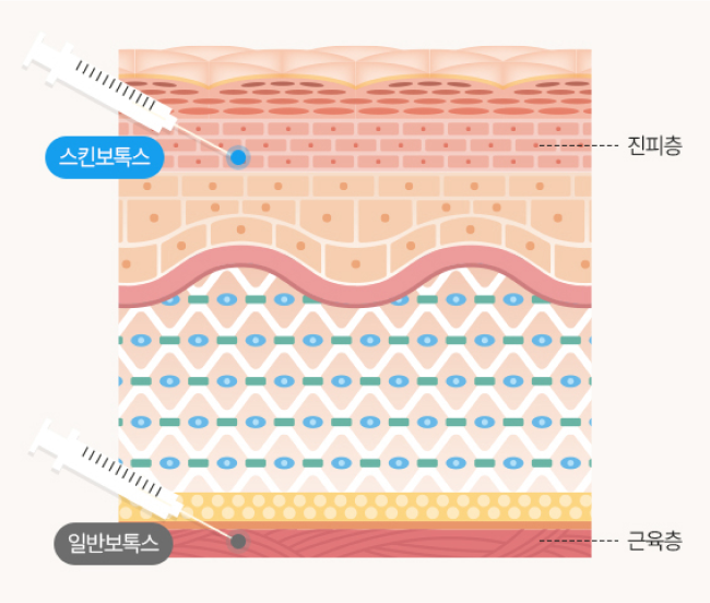 스킨보톡스