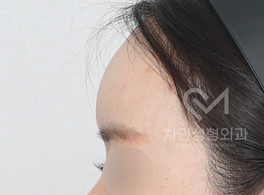전후사진