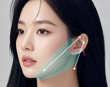 하안면부 리프팅