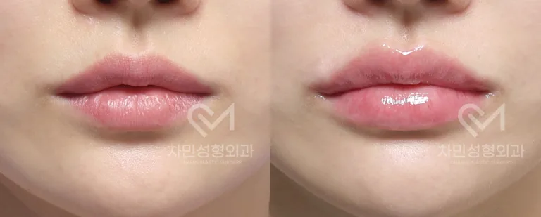 측면